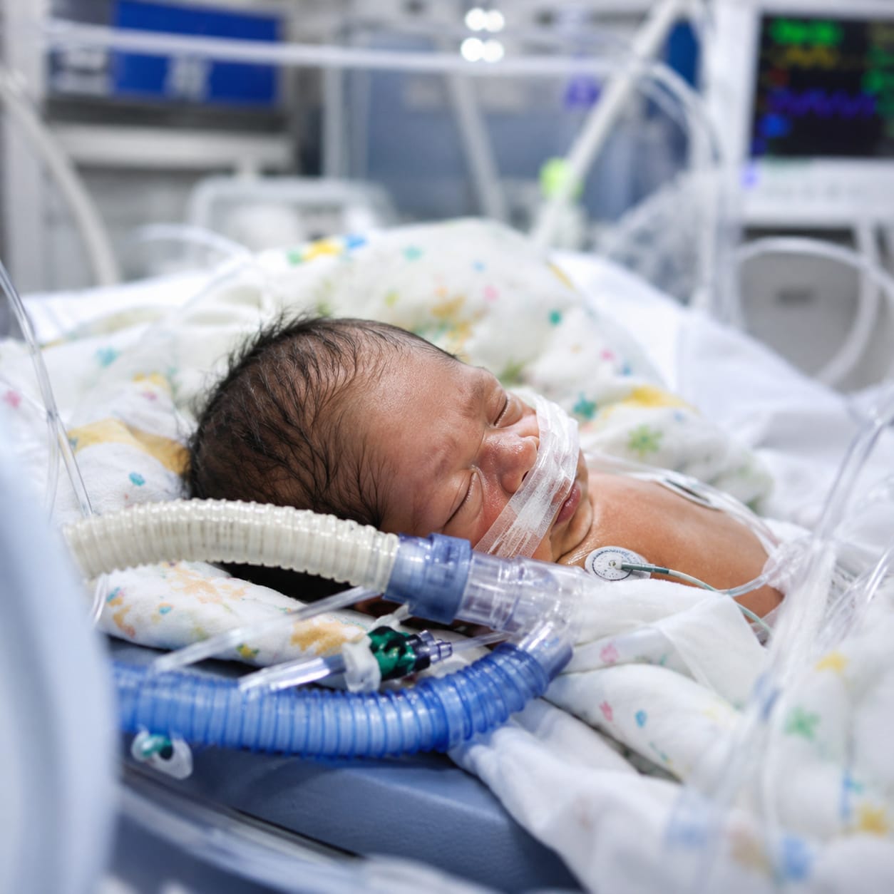 Prematurity-Related Breathing Problems