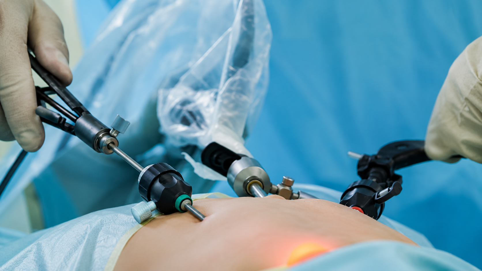 Tubectomy Treatment